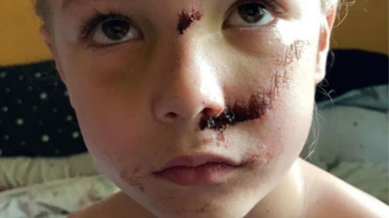 Jamie Smith, 6, suffered a broken skull after being hit by an electric scooter rider.  Pic: Leicestershire Police