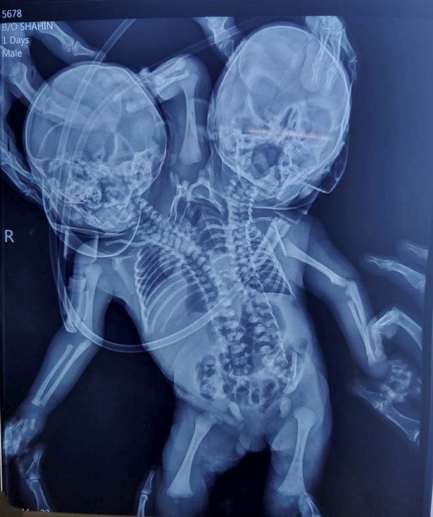 An x-ray of the baby born with two heads, three hands and two hearts in Madhya Pradesh, India